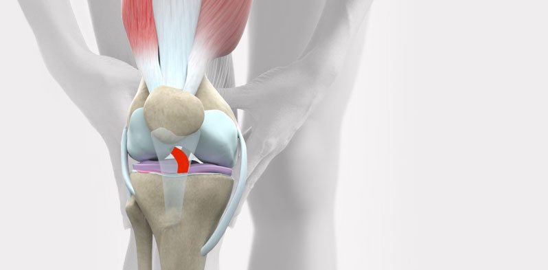 Déchirure du ligament croisé antérieur (LCA) - Chirurgie du genou ...
